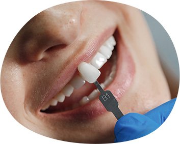 Diseño de sonrisa
